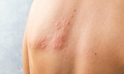 penyebab herpes