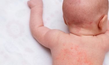 ruam kulit pada bayi
